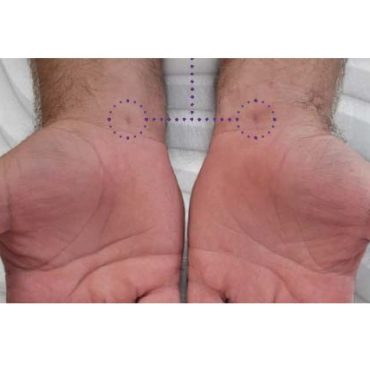 Sonex Health Outlines New Study of Carpal Tunnel Treatment Device