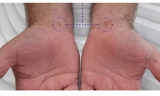 Sonex Health Outlines New Study of Carpal Tunnel Treatment Device