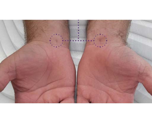 Sonex Health Outlines New Study of Carpal Tunnel Treatment Device