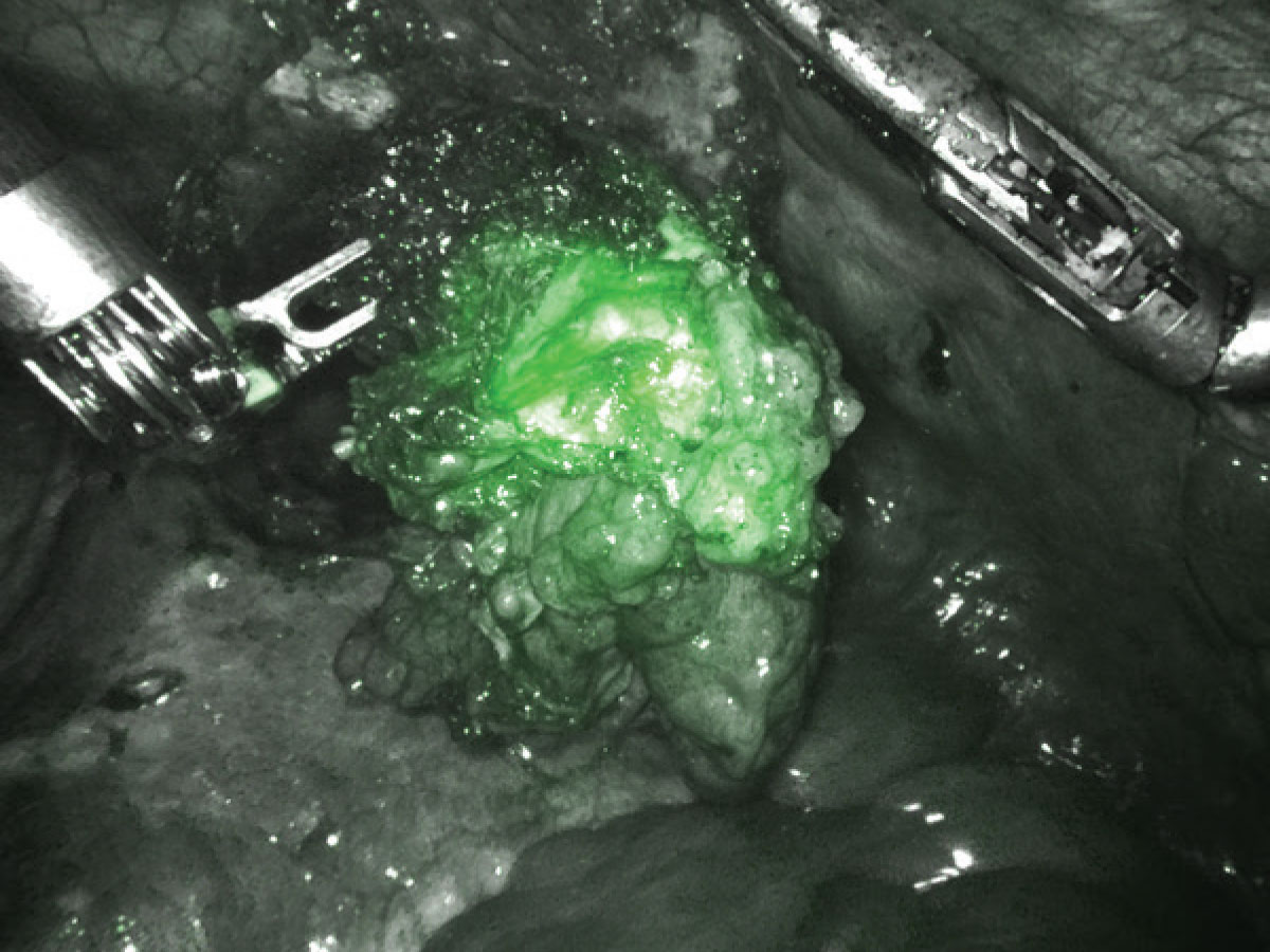 VGT-309 imaging agent makes tumors “light up.”