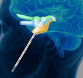 Eden Prairie Company Expands Med Tech Use to Chronic Pain Disorder