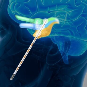 Eden Prairie Company Expands Med Tech Use to Chronic Pain Disorder