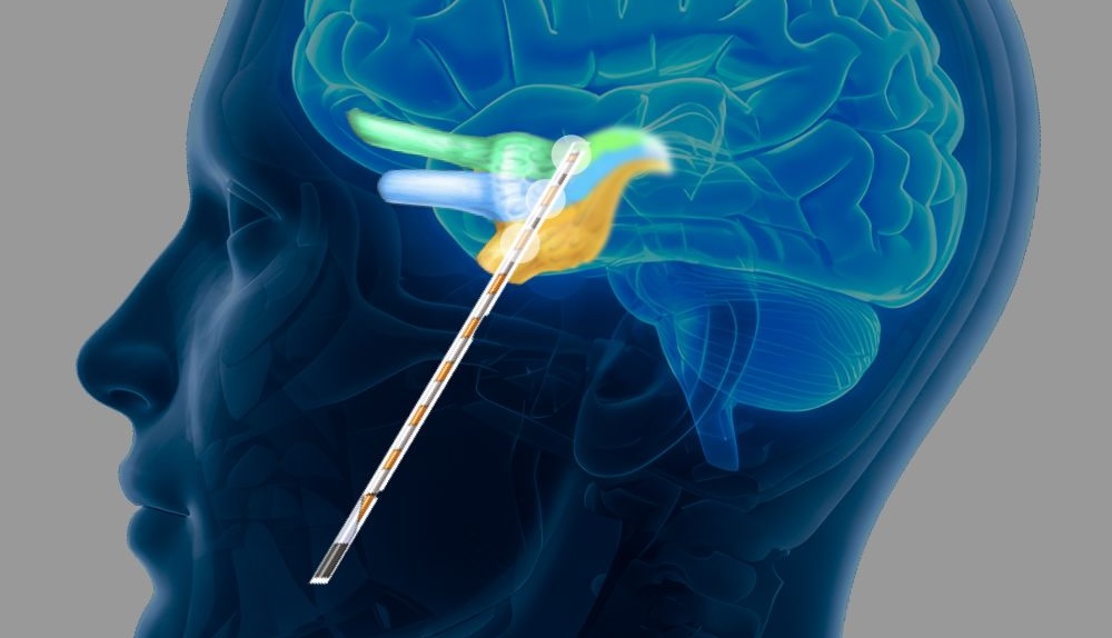 Eden Prairie Company Expands Med Tech Use to Chronic Pain Disorder