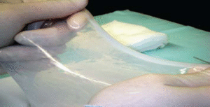 Peytant Solutions’ stent self-expands once inserted into a patient’s airways, and is made of human amnion, which has never been commercialized in the med tech industry for a stent.